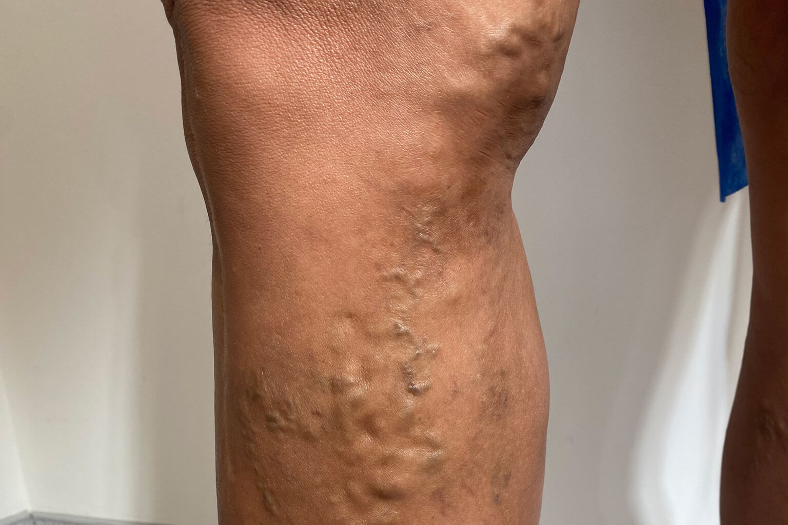 Avaliação vascular e tratamento de varizes com Dr. Rafael